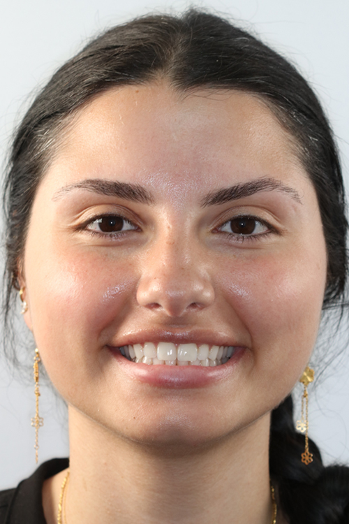 Woman smiling after cosmetic dental treatment at Balboa Dentistry in San Diego.