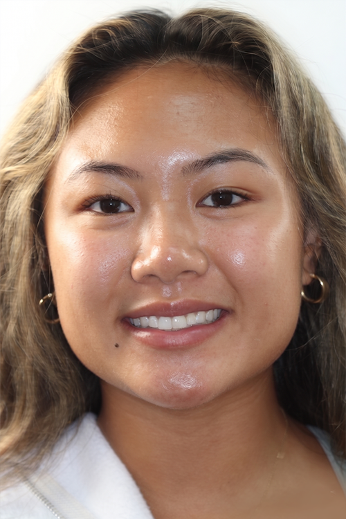 San Diego dental patient smiling after treatment.